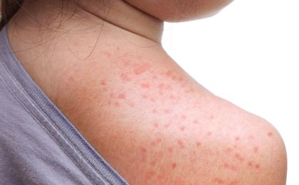 Mold Allergy: Symptoms, Treatment & Prevention