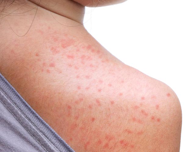 Mold Allergy: Symptoms, Treatment & Prevention