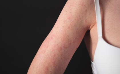 Black Mold and Eczema Black Mold and Eczema
