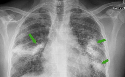 Connection Between Mold and Hypersensitivity Pneumonitis Connection Between Mold and Hypersensitivity Pneumonitis