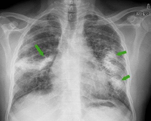 Connection Between Hypersensitivity Pneumonitis and Mold Exposure: Case Study