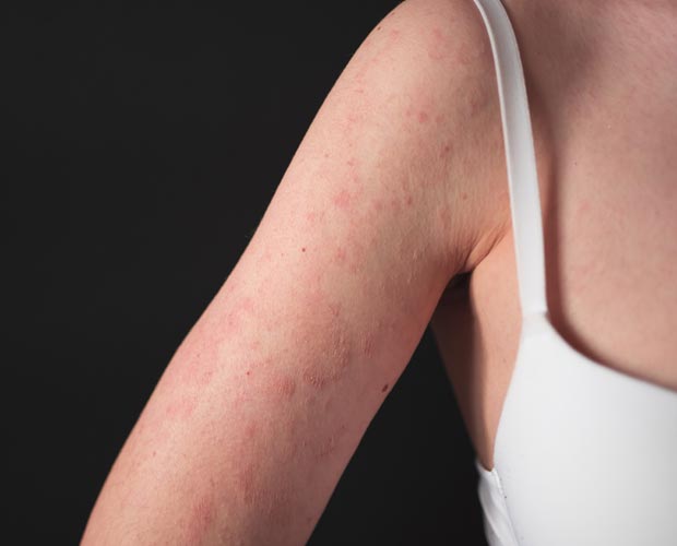 Can Black Mold Trigger Eczema?