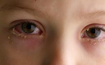 Can Mold Cause Conjunctivitis?
