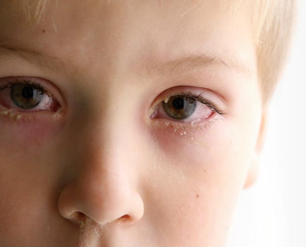 Can Mold Cause Allergic Conjunctivitis?